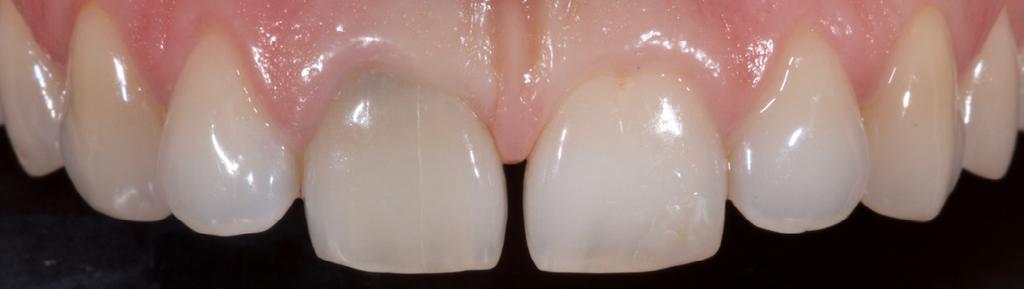trattamento sbiancante (per denti vitali o non vitali, a