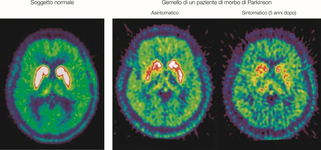 Morbo di Parkinson Perdita