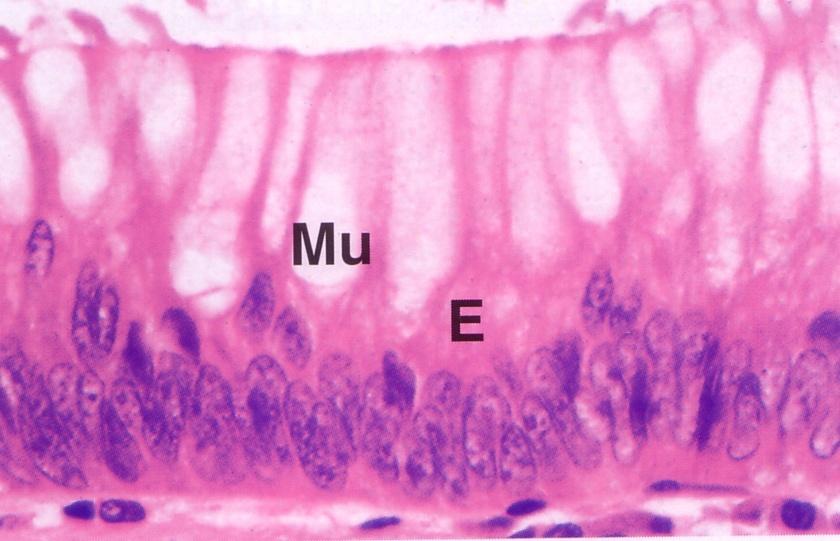 Neoplasia begnina del colon Cellule mucipare (Povere di muco)