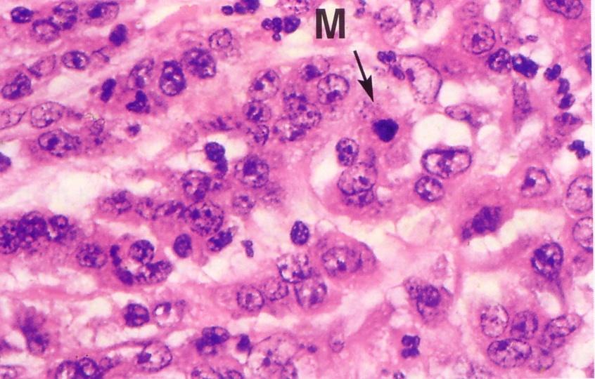 Neoplasia maligna del colon scarsamente differenziata Mitosi atipiche Variabilità della forma e delle dimensioni cellulari