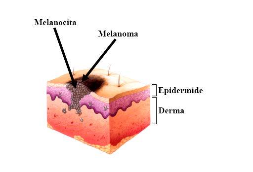 Il melanoma Il melanoma è un tumore cutaneo maligno che origina dai melanociti, cellule dello strato basale dell epidermide responsabili della produzione di