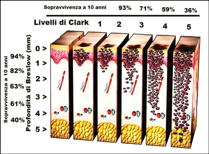 Vengono adottati vari sistemi di classificazione per descrivere la profondità di invasione: il più utilizzato è il Metodo di Clark e quello di Breslow (BW) In particolare: - lesione di Clark di 1