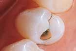 I rilevatori di carie Seek e Sable Seek consentono di identificare la dentina demineralizzata in aree difficilmente visibili, per esempio sotto lo smalto residuo nelle preparazioni di classe I, II e