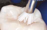 L accessibilità dello spazzolino STARbrush a preparazioni di classe I, II, III, IV, V e a cavità d accesso endodontiche è ineguagliabile.