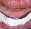 Il materiale OraSeal Caulking (a viscosità media) è indicato qualora sia difficile ottenere un sigillo adeguato in denti o radici compromessi.
