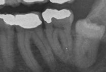 A destra: il dente del giudizio è in inclusione gengivale parziale, (coperto, quasi