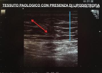 mediano di 184 mg/dl a 144 mg/dl, dopo i 6 mesi; tale