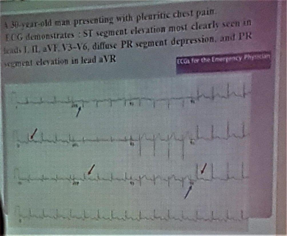 ha un ampiezza = ad 1/3 della successiva e dura 0,04 msec ma non sono affatto sicura perchè l ha detto superveloce] Depressione del tratto PR Bisogna fare DD con l infarto STEMI in cui il tratto ST è