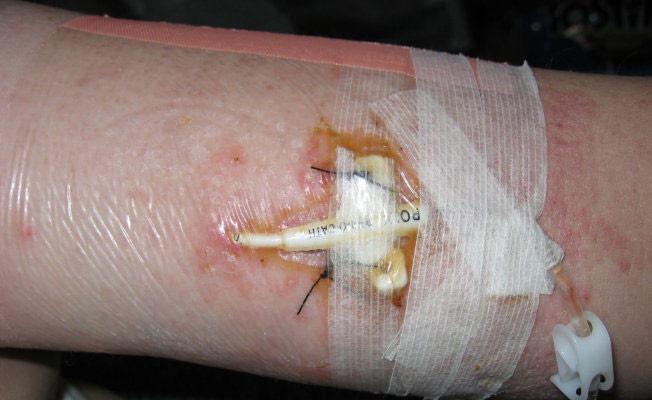 SVANTAGGI PUNTI DI SUTURA E bene evitare sempre l impiego di cerotti o suture, poiché non rappresentano una