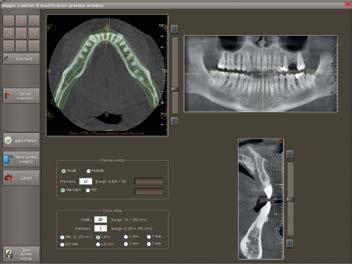NNT dispone di un applicazione dedicata alla pianificazione degli impianti, con la quale è possibile identificare e marcare l inclinazione della radice, la posizione del dente