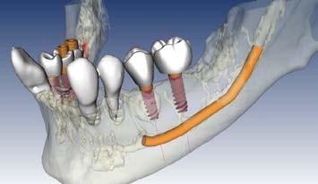 ossei. Inoltre, permette di visualizzare modelli ossei in 3D e calcolare la densità dell osso.