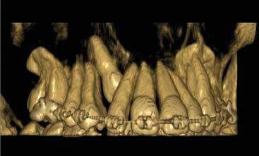 CASI CLINICI 3D Ortodonzia Per eseguire dei trattamenti ortodontici, per fini estetici o per la cura di patologie più gravi, la radiologia a fascio conico (Cone Beam) basandosi su