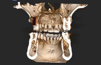 3D Implantologia Endodonzia-Periodonzia Le immagini ottenute da un volume 3D facilitano Lo specialista che si occupa