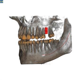 misurazione dell altezza e il trattamento di un dente fratturato, la terapia della profondità dei siti implantari, l