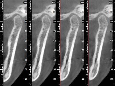 particolare della zona trattata, determinare l esatta Le immagini rivelano inoltre la densità dell osso patologia e