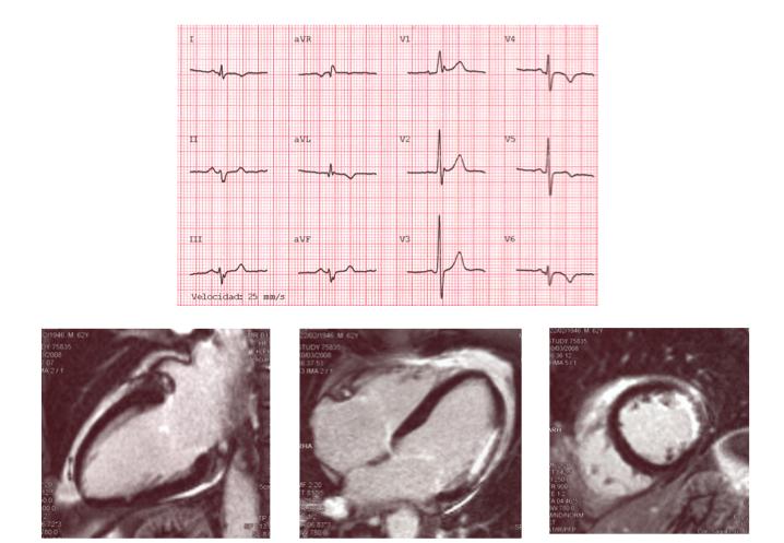 dell ampiezza dell onda R in V 6. Figura 1 Tracciato elettrocardiografico e risonanza magnetica con contrasto di un paziente con infarto miocardico laterale pregresso.