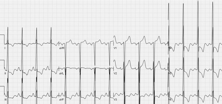 Figura 4 Onda T di aumentata ampiezza in un paziente con iperpotassiemia, tratta da 9. Figura 5 Ipertrofia ventricolare sinistra di grado severo con segni di sovraccarico, tratta da 16. 6.