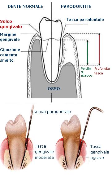 PROFONDITA DI SONDAGGIO (PD) Distanza