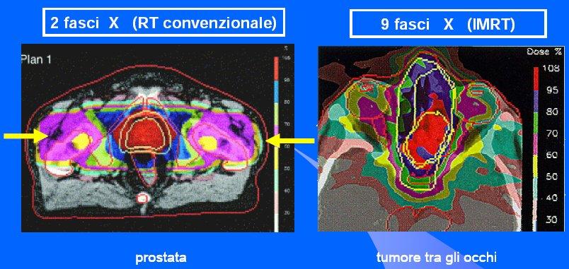 Esempi di soluzioni diverse adottate dai radioterapisti Possiamo pensare altre soluzioni per fare