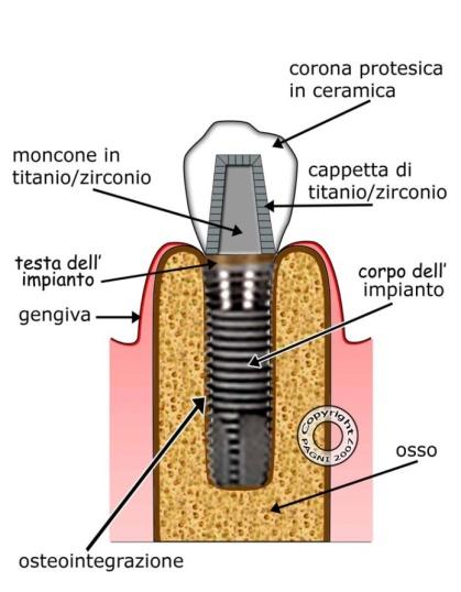 PDF 8. Impianti nel mascellare superiore se l osso è apparentemente insufficiente per l effettuazione di una Protesi Implantare Fissa.