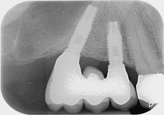Mettendo però un impianto obliquo, si guadagna lo spazio per un dente in più, per cui con due impianti si mettono tre denti dietro al