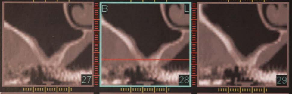 dell osso (trattino rosso) dietro all ultimo dente è insufficiente. Sopra a destra: la zona mascellare sinistra senza i molari.