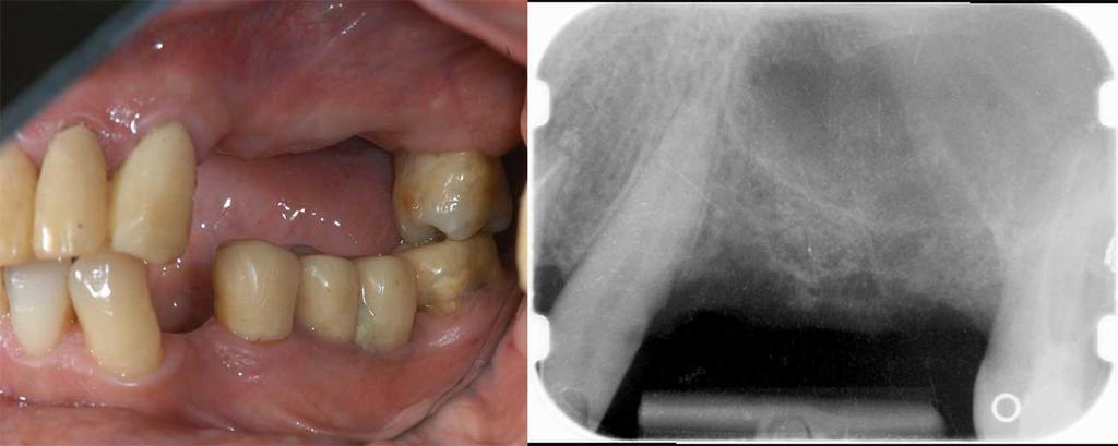 Caso 2. GRPSM in 1 fase. A sinistra. Mancano tre denti. Occorre inserire impianti per potere poi applicare denti fissi. A destra.