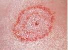 Tinea corporis Contagio frequenteente e da animali ( parti scoperte) e), ma anche interumano ( z zone coperte, piedi, inguini) In tutte