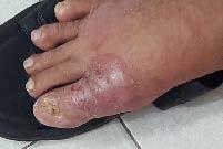 Tinea pedis Forma eritemato-squamosa Forma