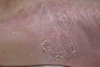 Tinea pedis Forma interdigitale ta e Forma eritemato