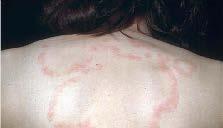 Tinea