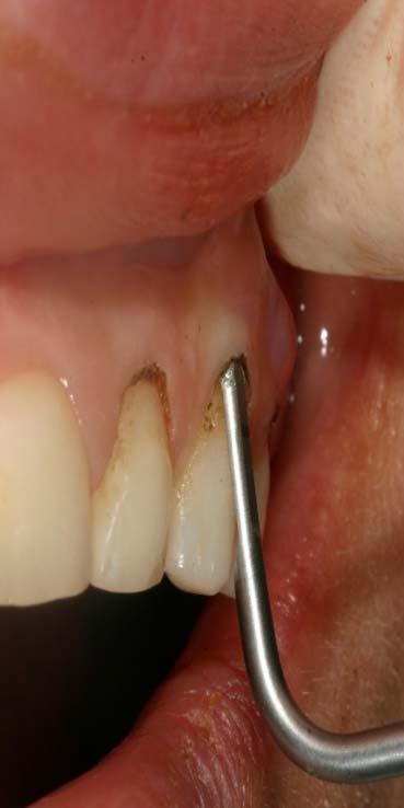 Punte soniche per allungamento chirurgico della corona Osteotomia (riduzione di osso) con una punta sonica SFS120 /121/122 per restaurare l ampiezza biologica inizialmente misurata, senza dover