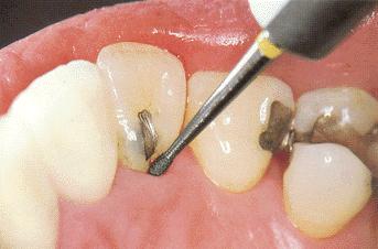 Schema di trattamento Terapia parodontale iniziale rimuovere tartaro e placca eliminare eccessi sporgenti di otturazioni e di margini coronali lucidare le superfici dentarie istruire e