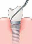 alla punta P2L per il debridement di filettature d impianto medie.