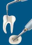 Irrisafe elimina in sicurezza il fango dentale, residui di dentina e batteri dal canale radicolare. La punta smussata previene ogni rischio di perforare l apice o le pareti del canale.