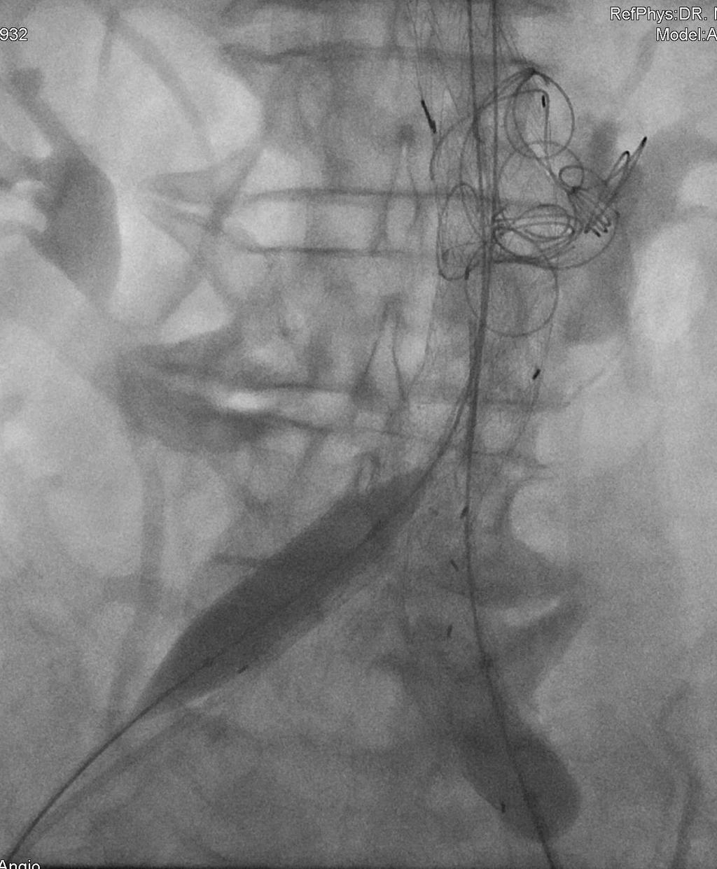 Tecnica: Fase 5 Occlusione delle branche con