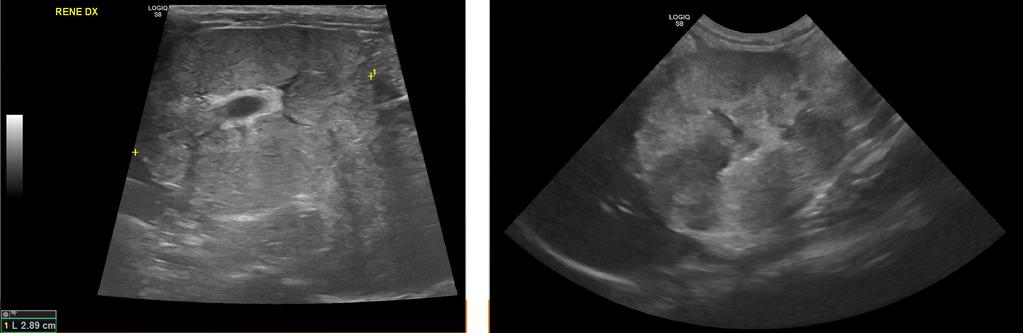 NEFROPATIA CRONICA END-STAGE KIDNEY Reni piccoli e forma irregolare Aumento generalizzato dell