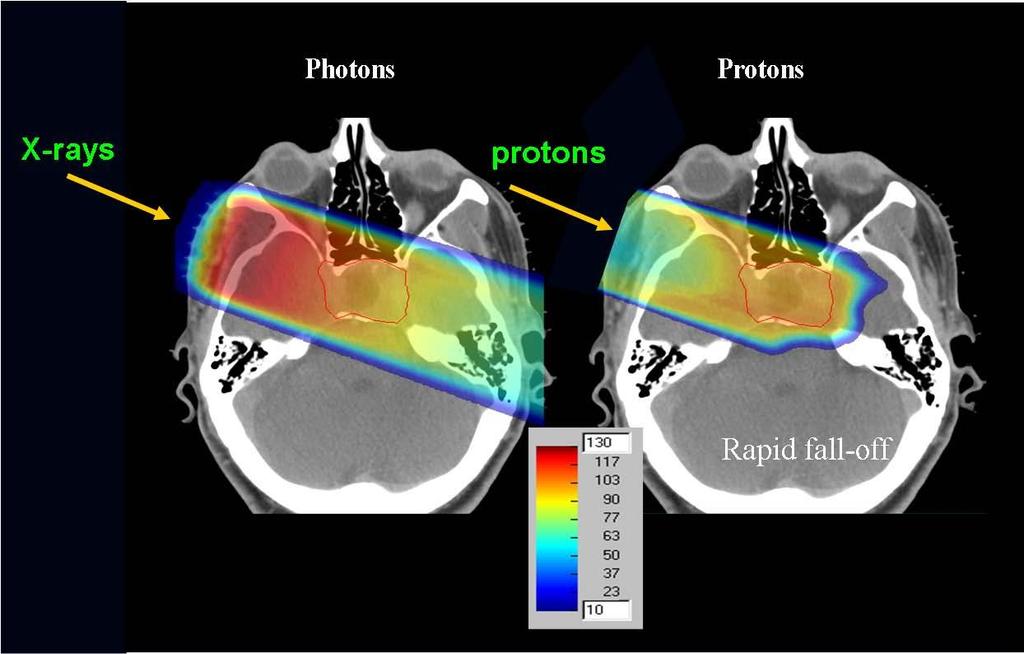 Adroterapia: proton beams vs x-rays Immagine tomografica (TAC): distribuzione di dose calcolata per un fascio di protoni e per raggi X Vantaggi Fisici Elevata densità di ionizzazione e range definito