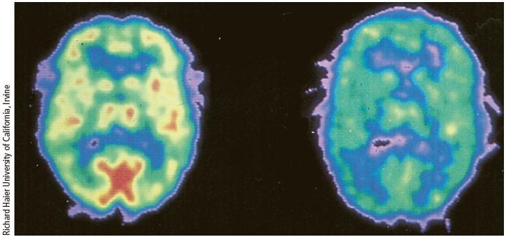 L efficienza del cervello Le aree in rosso, arancio e giallo indicano un alto consumo di glucosio; il verde, il blu e il rosa indicano aree a basso consumo.