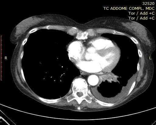 TC 19/04/16: comparsa di area consolidata alla base polmonare sx con atelettasia parziale; lieve incremento del versamento