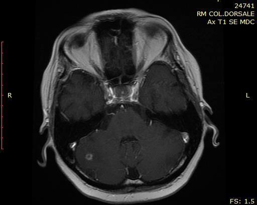 RM encefalo + colonna + bacino del 30/06/18: SD a livello osseo, comparsa di lesione frontale profonda dx, lieve