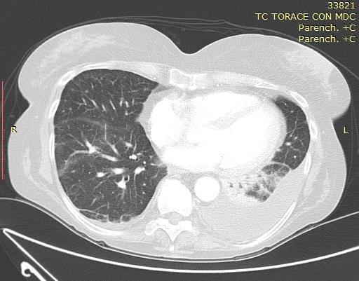 Agosto 2016: sospensione Ceritinib per tossicità epatica G3.