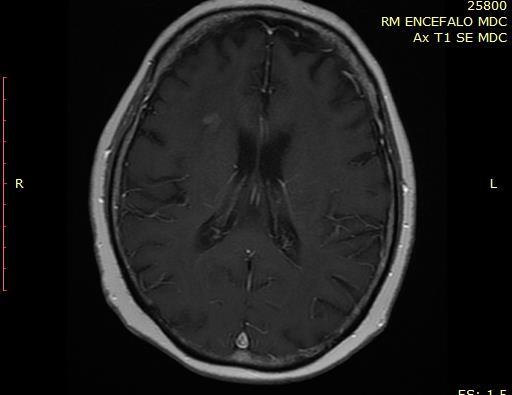 Ristadiazione di ottobre 2016: incremento della lesione frontale dx, comparsa di lesione occipitale omolaterale, stabile la lesione