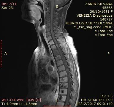RM encefalo del 02/12/2017: lieve riduzione della lesione cerebellare dx; comparsa di piccola area di impregnazione