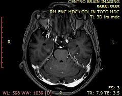 Durante il ricovero eseguita RM encefalo + rachide in toto (13/03/18): progressione meningea