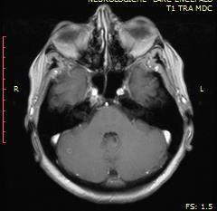 TC tb del 10/03/14 : «comparsa di lesioni occipitale sx (4 mm) e cerebellare dx (3 mm), sospette per secondarie; stabilità dei restanti reperti
