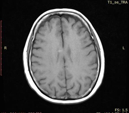 RM encefalo del 20/03/14: «presenza di aree di enhancement di mdc in sede cerebellare dx, corpo calloso, sede frontale dx» Condizioni cliniche