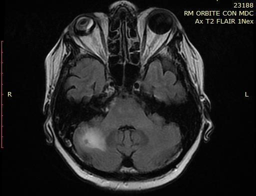 RM encefalo del 04/02/16: incremento della lesione cerebellare dx (8 m) ora con edema perilesionale. Ematochimici: ipertransaminasemia G1.