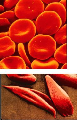 Gli eritrociti nell anemia falciforme hanno una forma a falce.