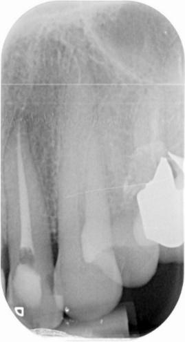 Radiografia 1: prima dell intervento